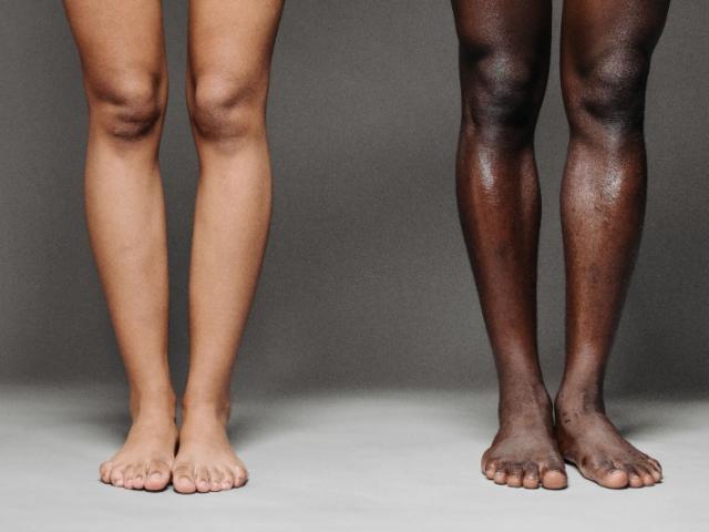Comment lutter contre les jambes gonflées avec la chaleur ? Comment lutter contre les jambes gonflées avec la chaleur ?